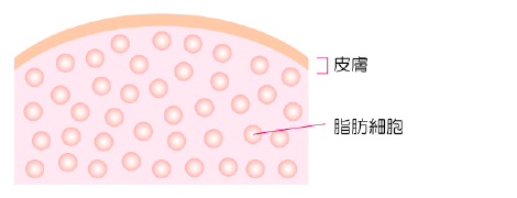 脂肪冷却ダイエットってどんな施術？