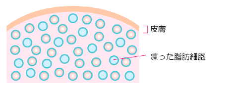 脂肪冷却ダイエットってどんな施術？