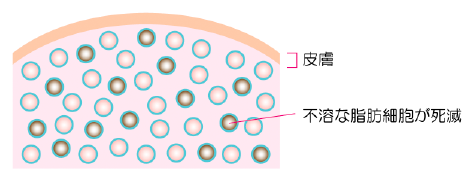 脂肪冷却ダイエットってどんな施術？
