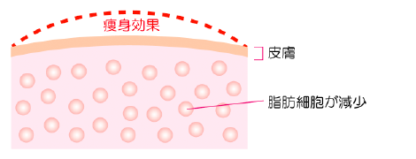脂肪冷却ダイエットってどんな施術？