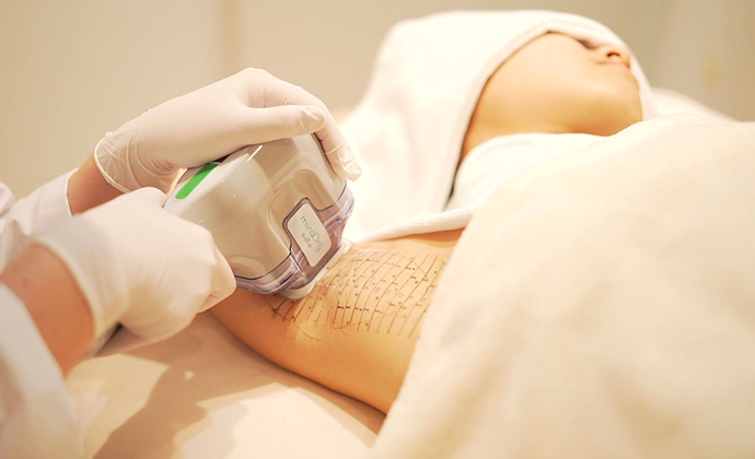 わきが・多汗症でFDAの承認