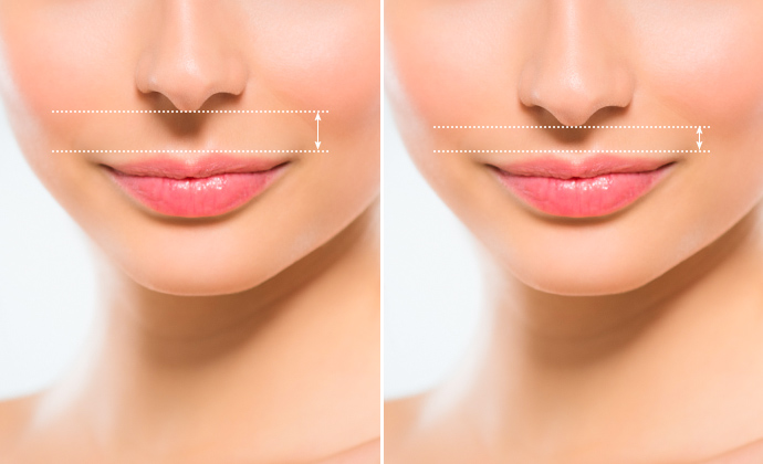 人中短縮（鼻の下を短くする）