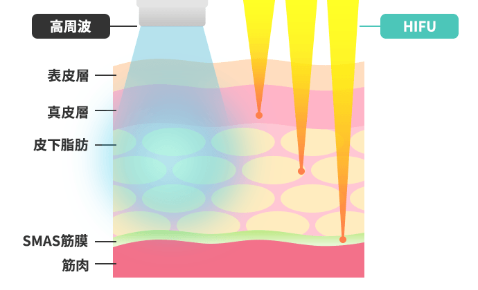 高周波との違い