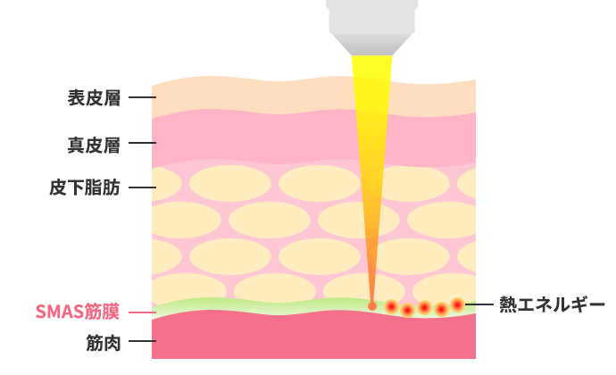 HIFUの仕組みと効果