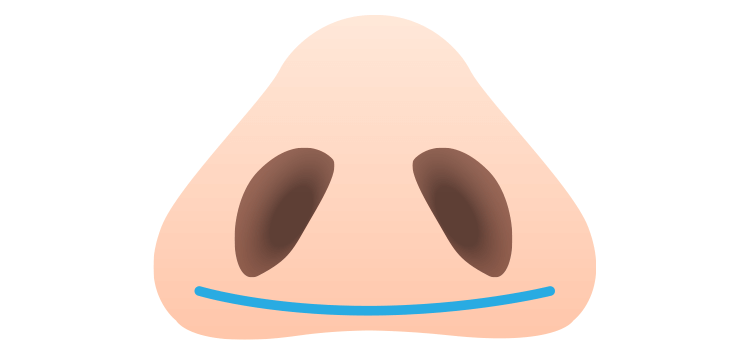 糸による小鼻縮小術(鼻翼縮小）