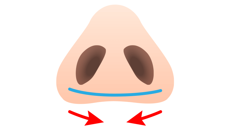 糸による小鼻縮小術(鼻翼縮小）