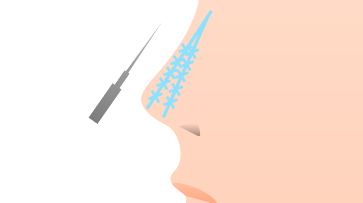 溶ける糸の挿入