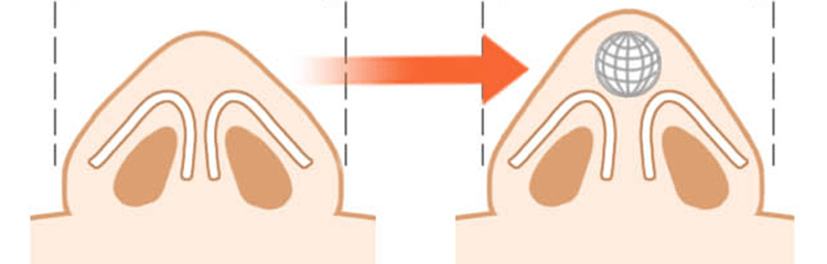 オステオポール 鼻先尖鋭術