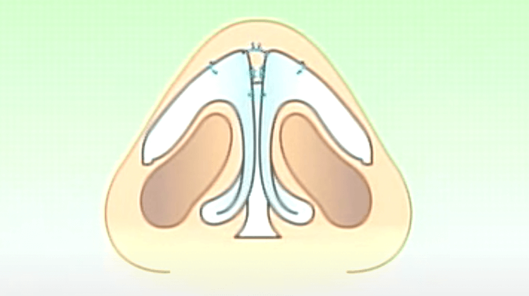 糸による鼻尖縮小術(鼻先修正)