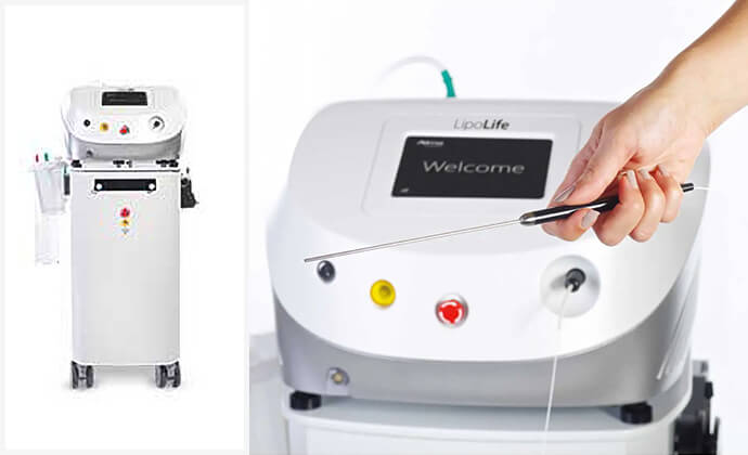 最新治療②ダイオードレーザー（ライポライフ）脂肪注入