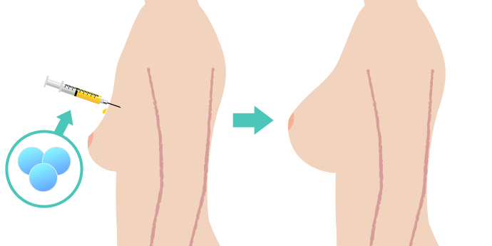 ヒアルロン酸注入豊胸術