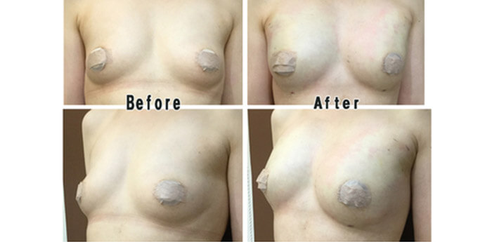 ピュアグラフト豊胸術