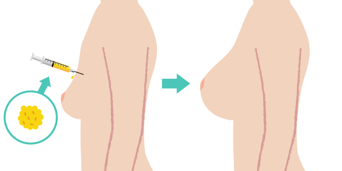 脂肪注入豊胸術