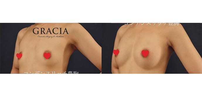 コンデンスリッチ豊胸術