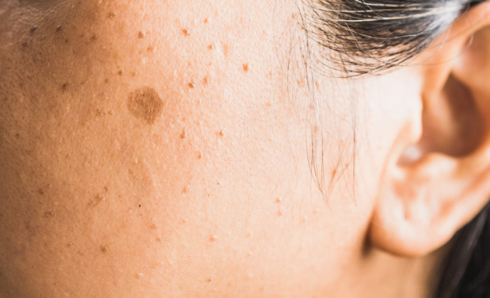目立つ濃い目のシミ