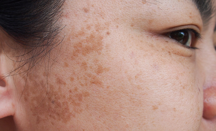 広範囲にある細かく浅い層のシミ