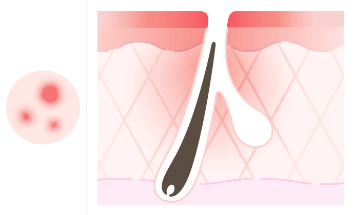 赤みがある平面のニキビ跡