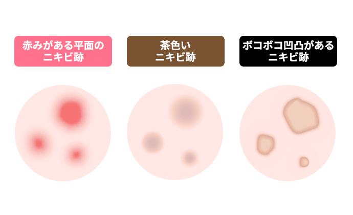 3種類のニキビ跡