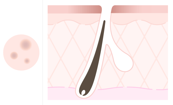 茶色いニキビ跡