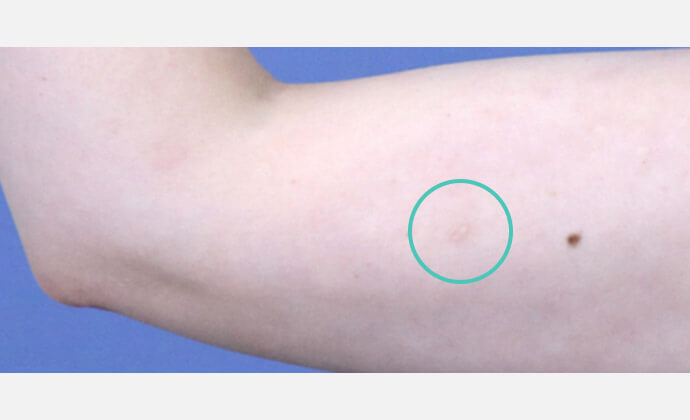 脂肪吸引後 3ヶ月の傷跡
