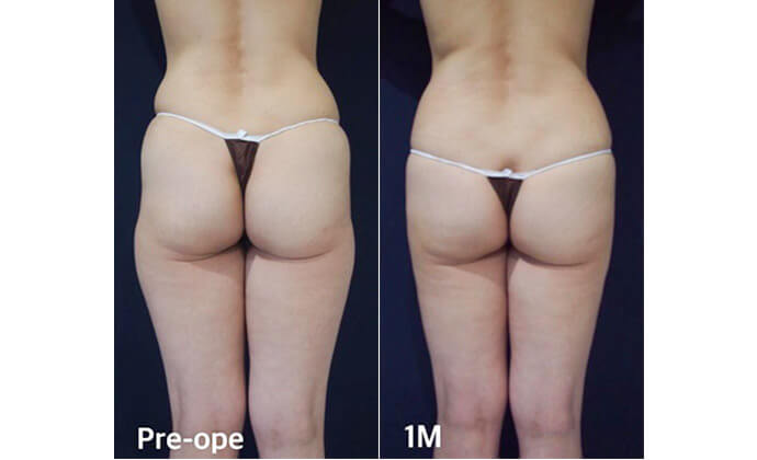 脚（もも、ふくらはぎ）・ヒップ