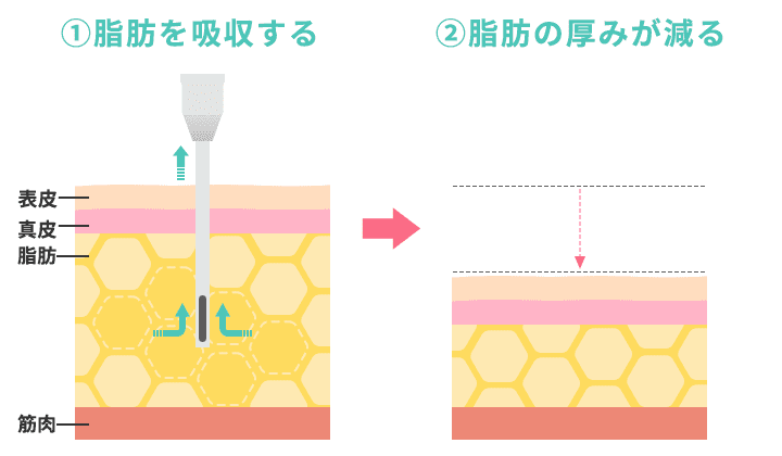 脂肪吸引で痩せる仕組み