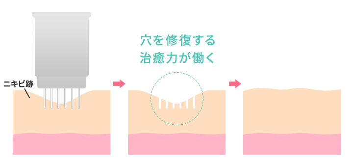 ダーマペン治療のイメージ