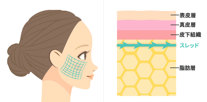 【浅め】皮膚層に格子状に入れてハリを出すショッピングリフト（サーフェススレッド）