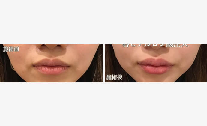 ③リップ整形の定番 「ヒアルロン酸注入」