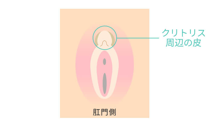 クリトリス包茎の治療（陰核包皮除去）