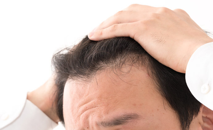 AGA（男性型脱毛症）
