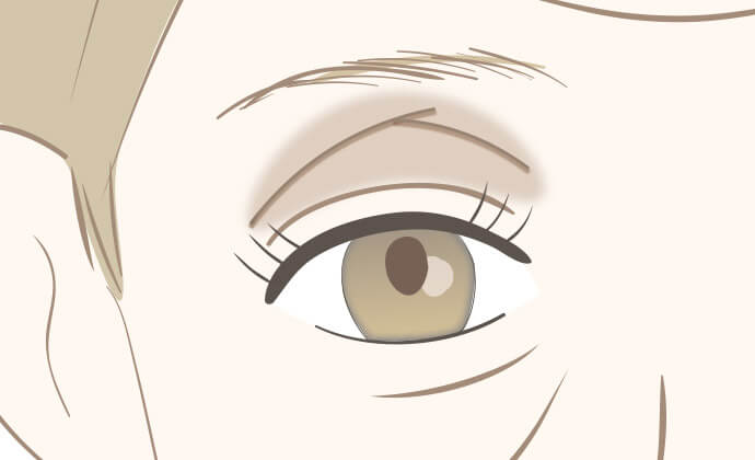 「くぼみ目」「サンケンアイ」と呼ばれる上まぶたの凹み