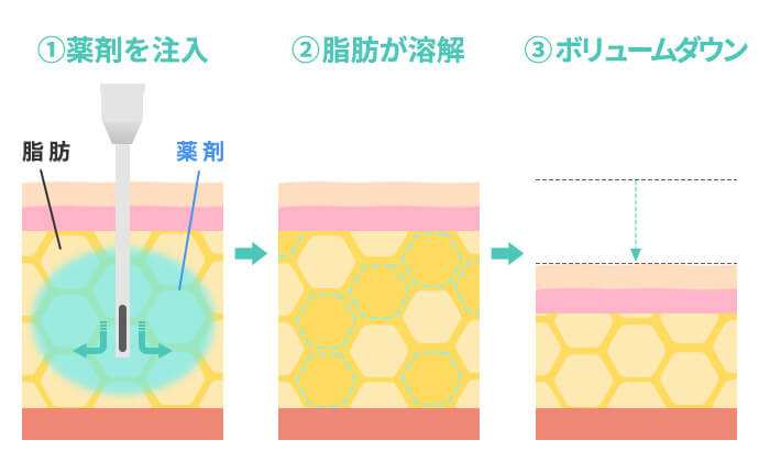 脂肪溶解注射の仕組み