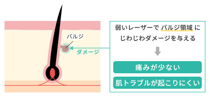 蓄熱式脱毛の仕組み