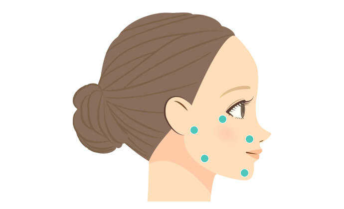 BAP法の注射部位