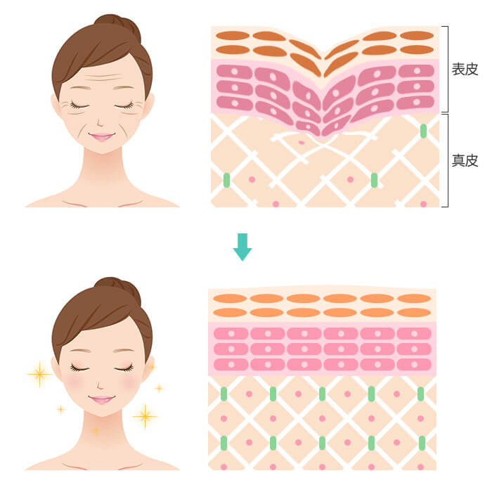 バイオリモデリング製剤注入後の変化