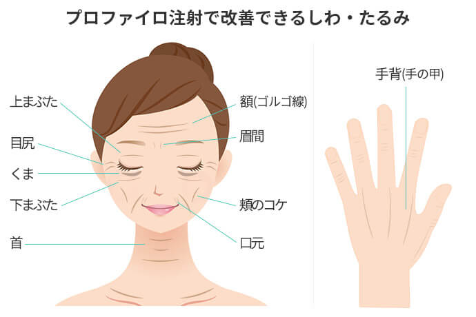 プロファイロ注射で改善できるしわ・たるみ