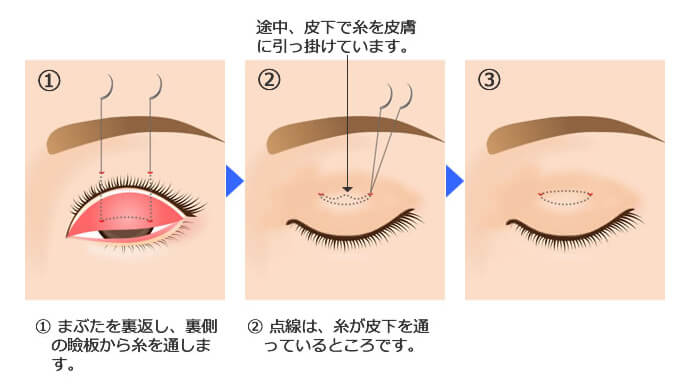 ループ式埋没法
