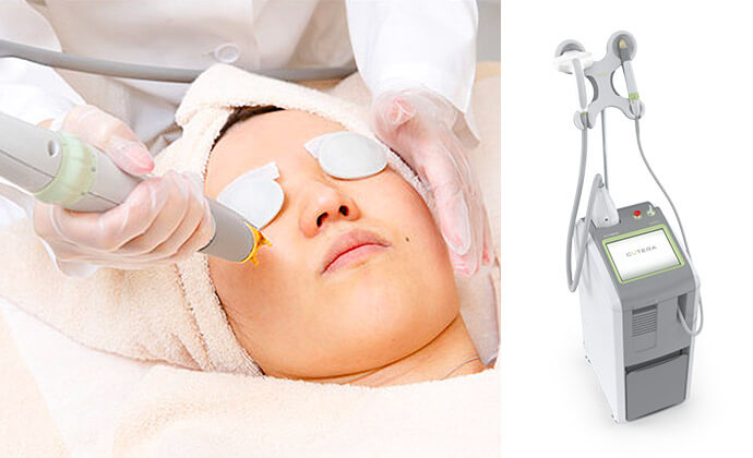 ジェネシス（ヤグレーザーピーリング）