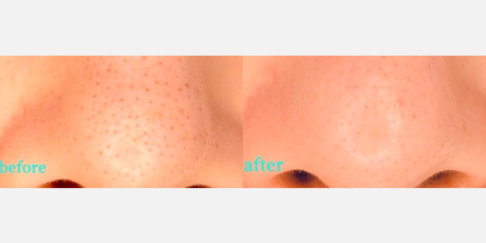 ハイドラフェイシャルの症例