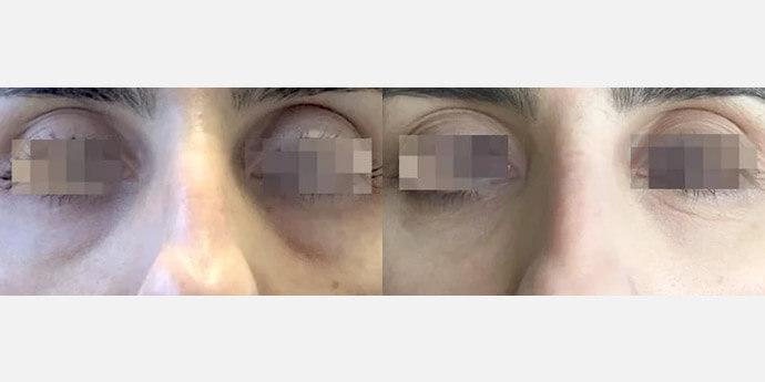 スネコスの症例