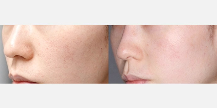 ダーマペンの症例