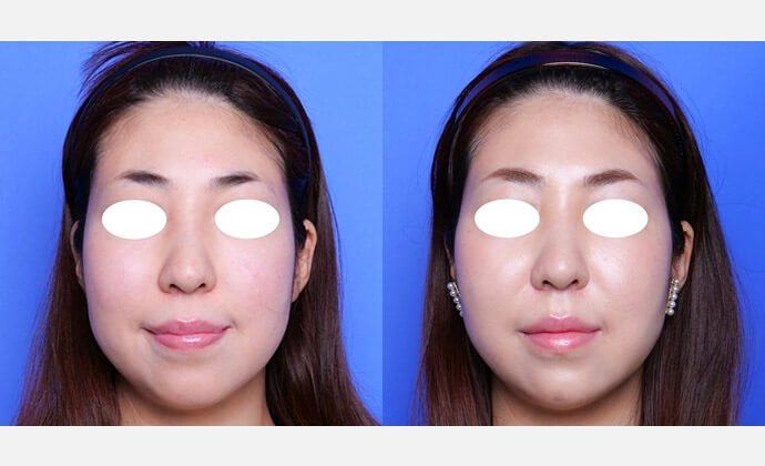 糸リフト（テスリフト）