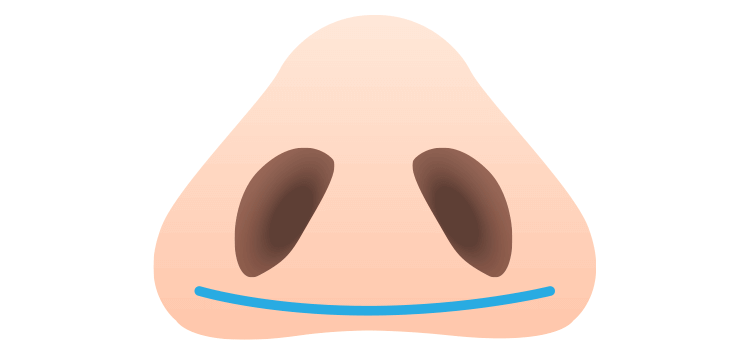 幅を狭める「鼻翼縮小術」