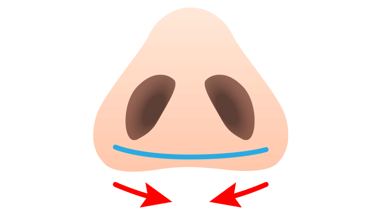 幅を狭める「鼻翼縮小術」