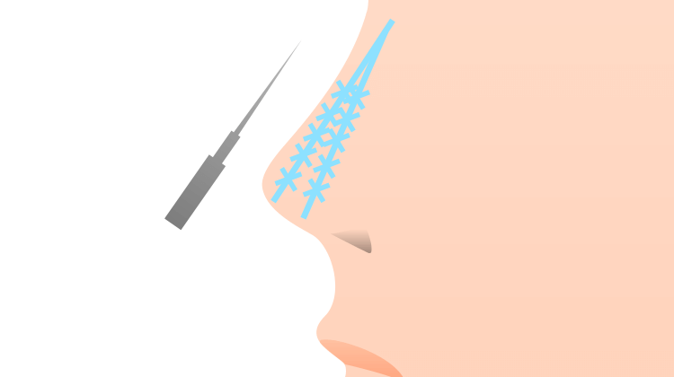 鼻筋が通った高い鼻へ「隆鼻術」