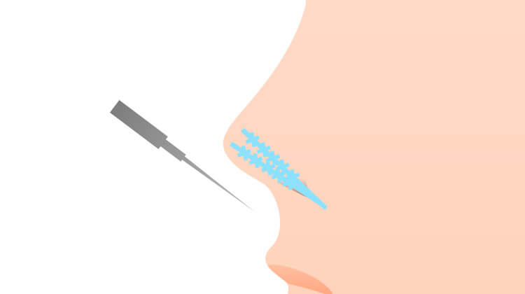 アップノーズにする