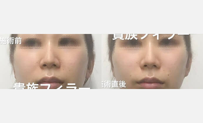 ヒアルロン酸注入法