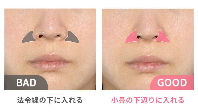 鼻翼基部プロテーゼ挿入術