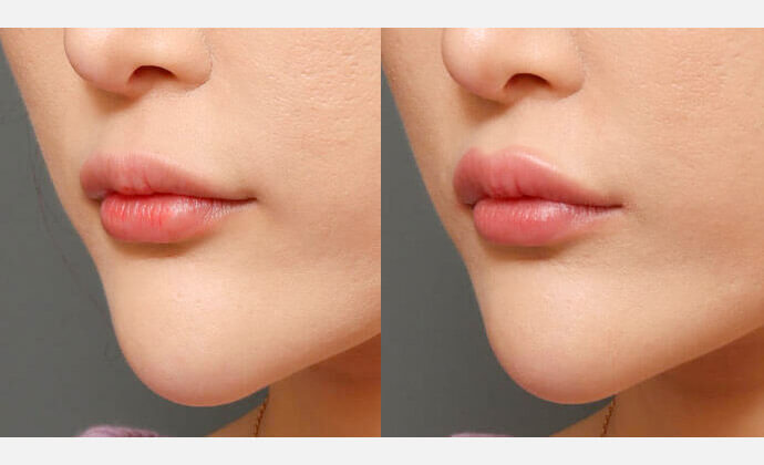 人中短縮ボトックス